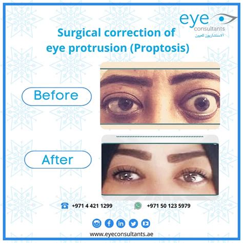 Best Oculoplastic Surgeon In Dubai Blepharoplasty