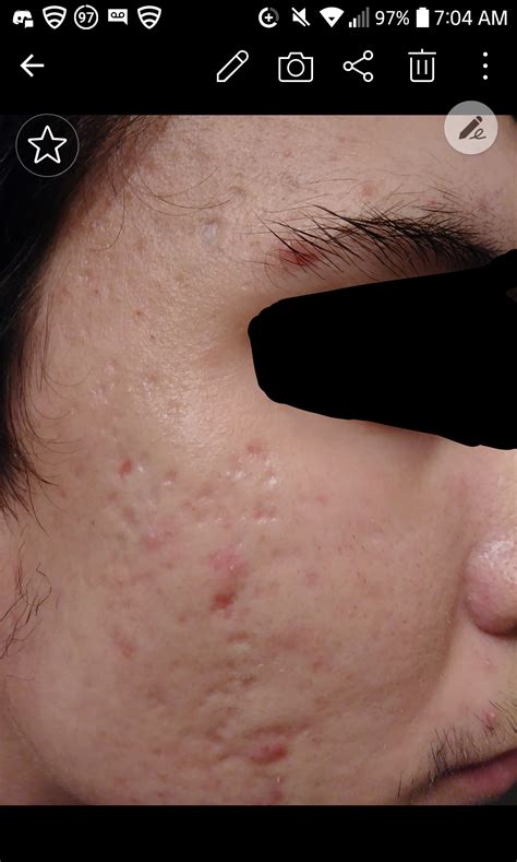 Acne Scar And Diagnosis Hypertrophic Raised Scars
