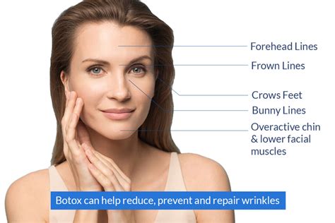botox azzalure to reduce wrinkles