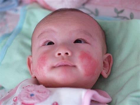 Baby Eczema Symptoms Causes Treatments And Triggers Skin Disease