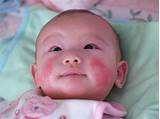 Baby Eczema Flare Up Treatment Photos