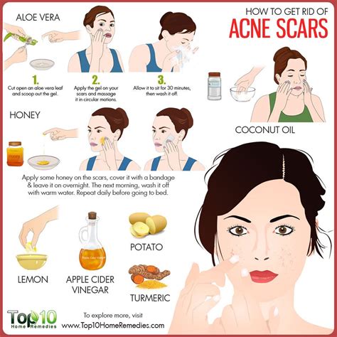 For acne scars, let them heal on their own. How to Get Rid of Acne Scars | Top 10 Home Remedies