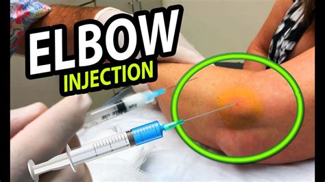 Elbow Cyst How To Treat Tennis Elbow Youtube