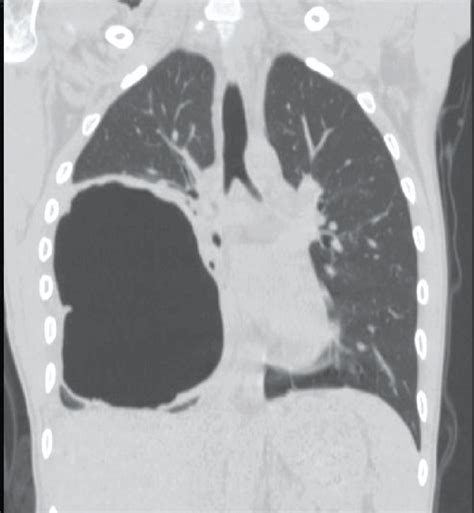 Postoperation Radiography Of A Pulmonary Hydatid Cyst With