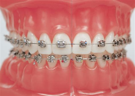 How Much Do Braces Cost In The Uk The Dental Guide