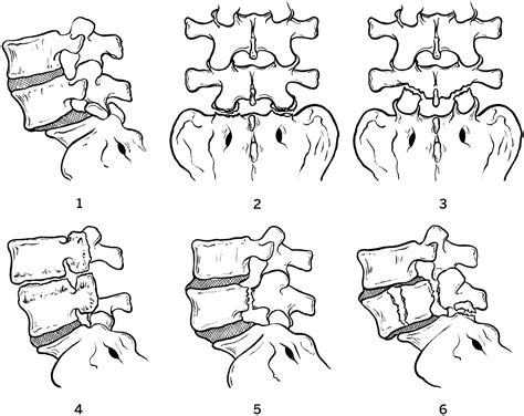 Traumatic Lumbar Spondylolisthesis A Systematic Review And Case Series