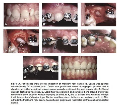 Pdf Surgical And Orthodontic Management Of Impacted Maxillary Canines