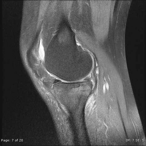 Spontaneous Osteonecrosis Of The Knee Sonk Tibial Image