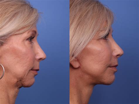 Facelift Before And After Pictures Case 267 Scottsdale Az Hobgood Facial Plastic Surgery