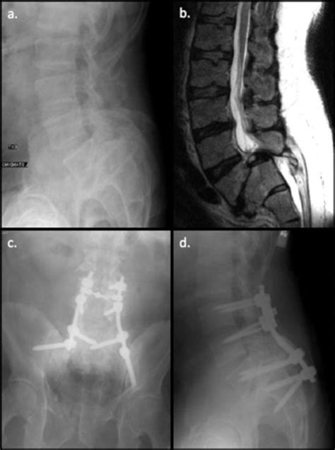 High Grade Spondylolisthesis In Adults Current Concepts In Evaluation