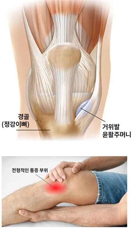 Knee Pain Pes Anserine Bursitis