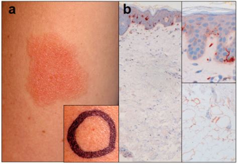 Clinical Findings In Delayed Type Allergy Against Local Open I