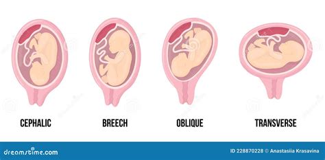 Different Wrong Baby Positions In Uterus During Pregnancy Cephalic