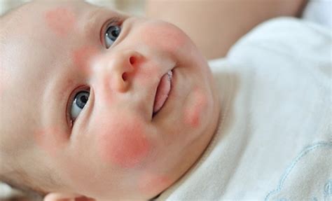 Alergias de pele o que você precisa saber para proteger o seu filho no