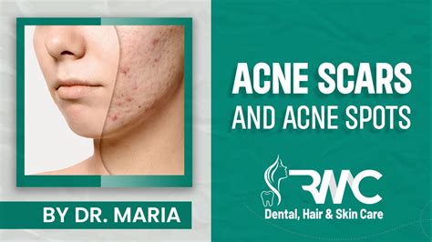 Acne Scars And Acne Spot Treatment Dermatologist Rehman Medical