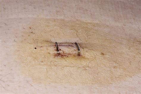 Wound Suture Free Stock Photos Images And Pictures Of Wound Suture