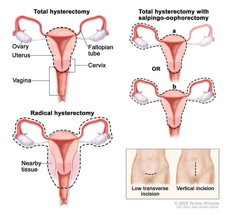 Total Hysterectomy Radical Hysterectomy And With Salpingo