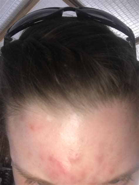 Routine Help Cluster Of Eight Blind Pimples On Forehead R