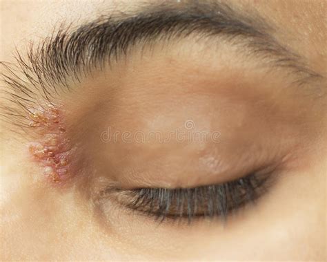 Have systemic antivirals made a difference? Herpetic Eye Disease - Herpes Zoster Ophthalmicus Stock Photo - Image of rash, chickenpox: 40201394