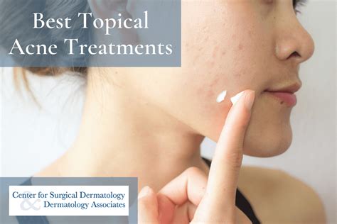 Best Topical Acne Treatments Dermatologists Want You To Know About