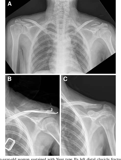 Figure 1 From Surgical Treatment Of Unstable Distal Clavicle Fractures