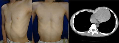Nuss Procedure For Patients With Pectus Excavatum With A History Of Intrathoracic Surgery