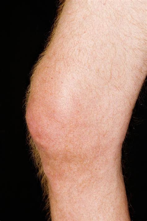 Gout In The Knee Photograph By Dr P Marazzi Science Photo Library