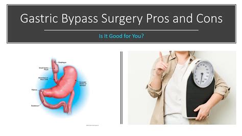Gastric Bypass Surgery Pros And Cons Is It Good For You Youtube
