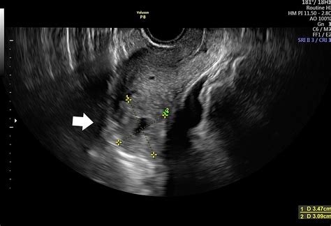 Cureus Interstitial Pregnancy Case Report Of Atypical Ectopic Pregnancy