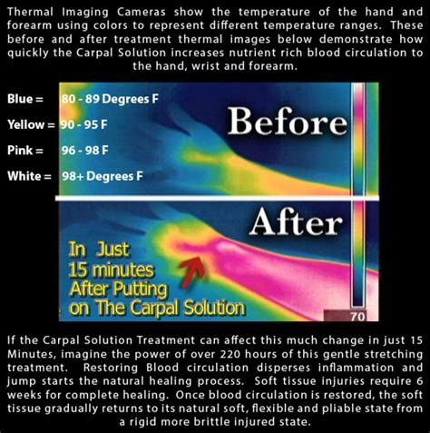 Maybe you would like to learn more about one of these? How Long Does it Take to Cure Carpal Tunnel Naturally ...