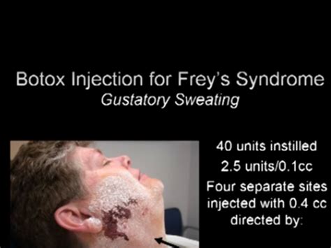 Botox Botulinum Toxin Injection For Freys Syndrome Iowa Head And