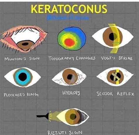 Dr Hamza On Twitter OGdukeneurosurg Keratoconus Munson Sign Other