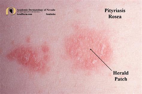 Pityriasis Rosea Collarette Scale