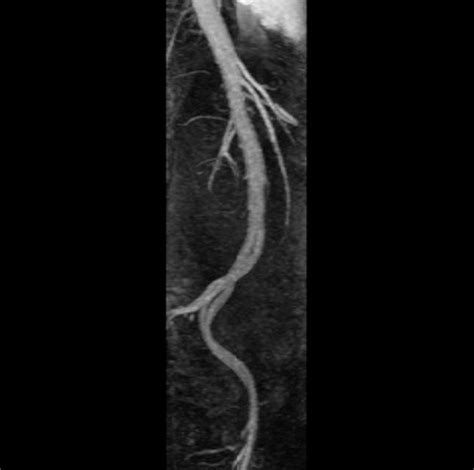Peripheral Arterial Occlusive Disease Mra Radiology Case