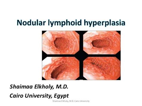 Diffuse Nodular Lymphoid Hyperplasia Dnlh