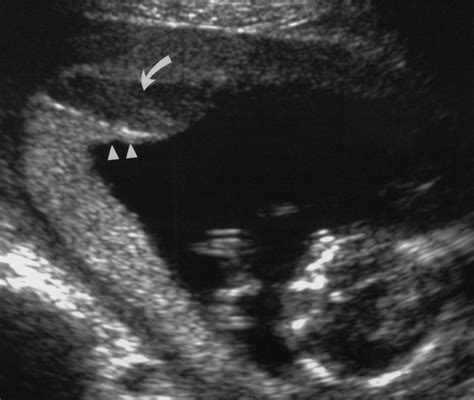 Hemorrhage During Pregnancy Sonography And Mr Imaging Ajr