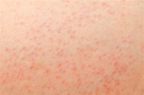 Itchy Skin At Night Preserve Your Skin By Changing Your Bed Sheets