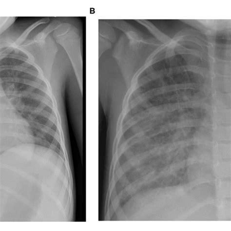 Chest X Ray At The Day Of Admission A Showing Diffuse Bilateral
