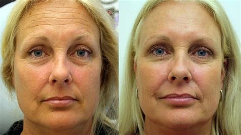 Botox Treatments Lehi Botox Injections Saratoga Springs