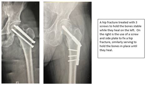 Bipolar Hemiarthroplasty Vs Total Hip Replacement