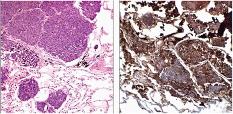 Neuroendocrinesmall Cell Carcinoma Basicmedical Key