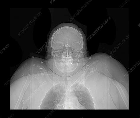 Obesity X Ray Stock Image C0271851 Science Photo Library
