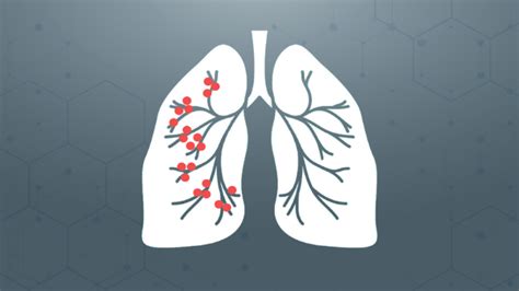 Lung Cancer Can Strike Non Smokers As Well