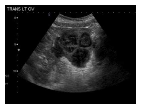 Ultrasound Image Showing Large Complex Cystic Mass In The Left Adnexa