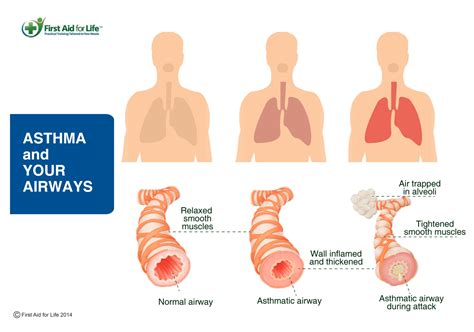 Asthma Stay Safe For Older People