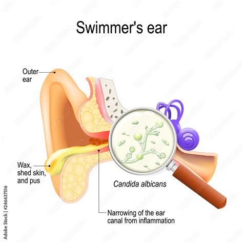 otitis swimmer s ear is inflammation of the ear canal and fungal infection that caused this