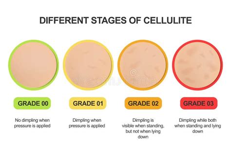 Different Stages Of Cellulite Grading Scale Treatments Stock Vector