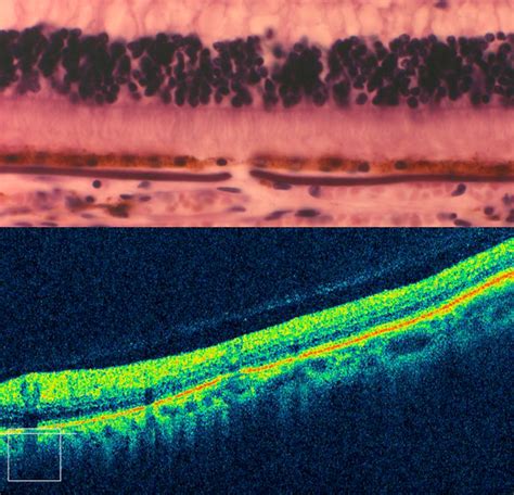 Angioid Streaks Light Microscopy And Oct Retina Image Bank