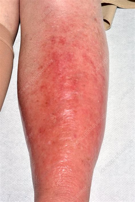 Itchy Cellulitis Of The Leg Hot Sex Picture