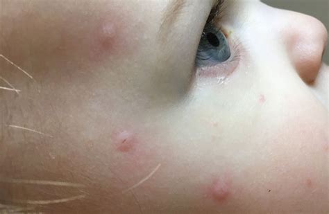 Bed Bug Bites On A Baby